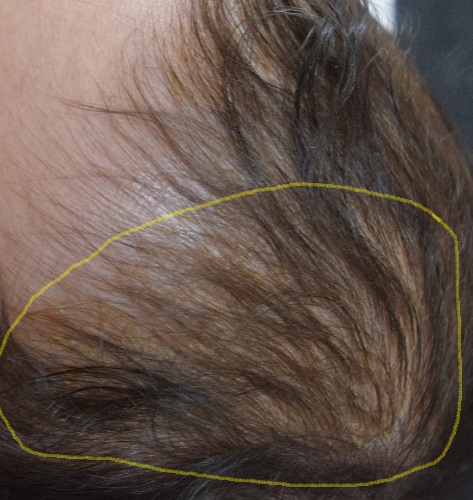 写真あり 医者から聞いた赤ちゃんの頭皮にあるうろこの改善方法
